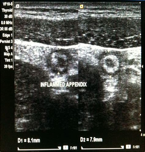 Figure 1 Usg Showing Target Sign Of Inflamed Appendix With Wall To