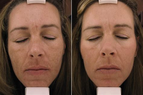 The Way You Designed Best Treatment Melasma Face Renewal Skin