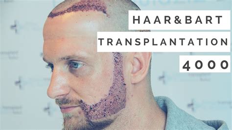 Haartransplantation Und Barttransplantation In Istanbul Erfahrung YouTube