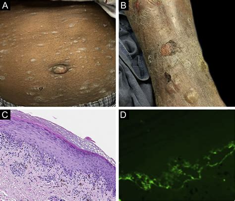 What Is Lichen Planus Pemphigoides A Highlight Of Three Cases With