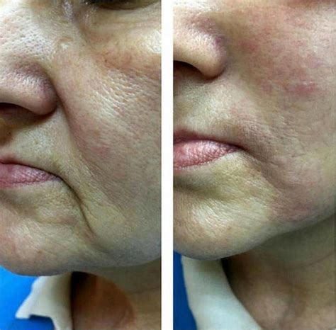 Radio Frequency Facelift Treatment Before And After 8 Facelift