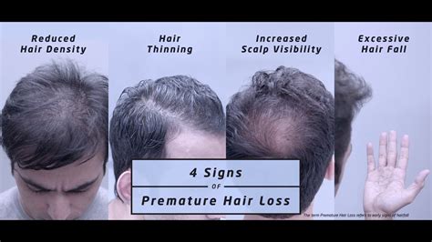 Livon Hair Gain The Four Signs Of Premature Hair Loss Youtube