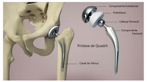 O que é a prótese de quadril Voglia Ortopedia