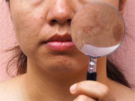 Homeopathic Remedies For Melasma Health N