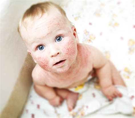 Rashes may cause the skin to change color, itch, become warm, bumpy, chapped, dry, cracked or blistered, swell, and may be painful. How to Recognize Food Allergies in Babies - Beyond Organic ...
