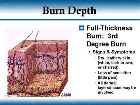 Chapter 21 Burns Topics Introduction To Burn Injuries