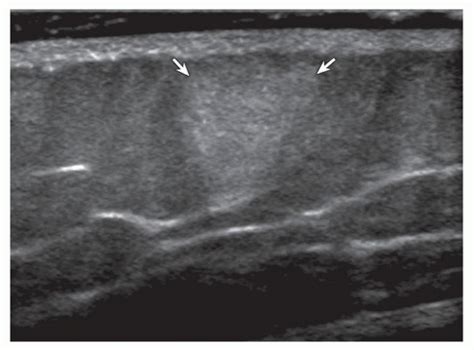 Lipoma Ultrasound Image Shows Round Hyperechoic Subcutaneous Lipoma