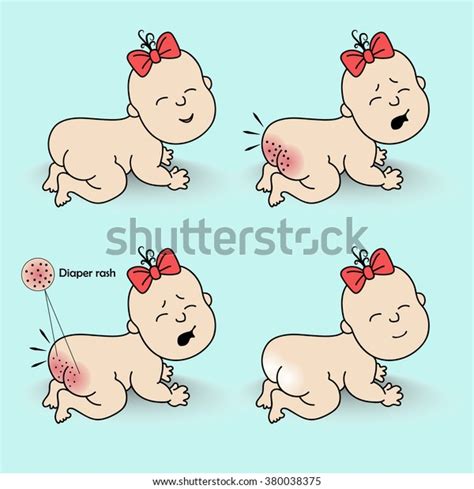 Set Diaper Rash Stock Vector Royalty Free 380038375