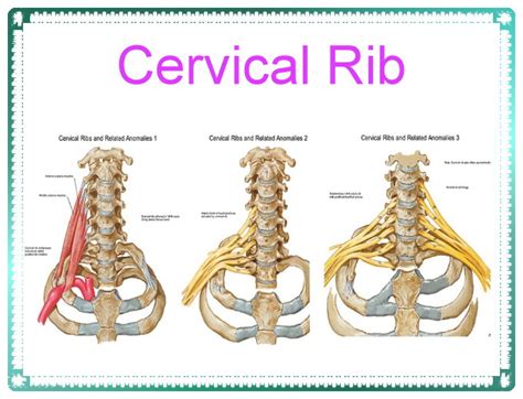 Cervical Rib Sure Developers Team