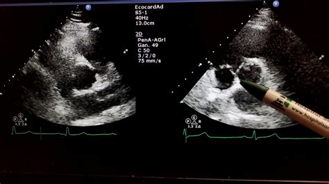 Valvula Aortica Aorta Bivalva Ecocardiograma Cardiologia Puerto