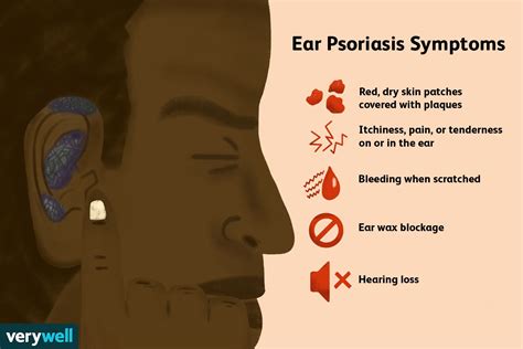 Ear Psoriasis Symptoms Causes Diagnosis And Treatment