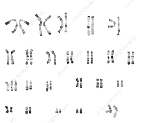 trisomy 13 karyotype female stock image c003 0983 science photo library