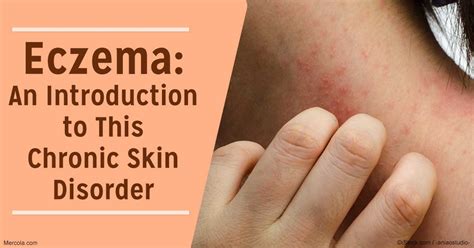 Eczema An Introduction To This Chronic Skin Disorder