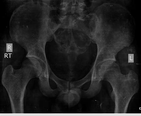 Anteroposterior Radiograph Of The Pelvis Showing Patchy Calcification