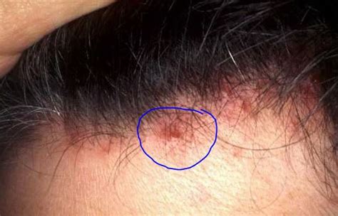 Pimples On Scalp Causes Small Painful Itchy Get Rid Treat Scalp