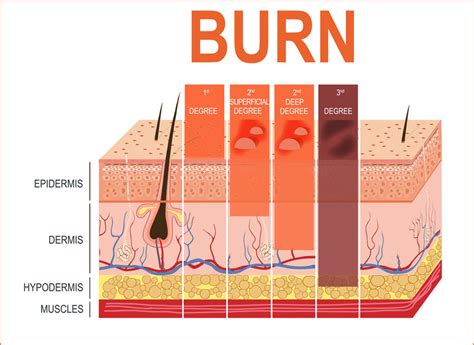 The Different Degrees Of Burn Wounds According To Skin Structure