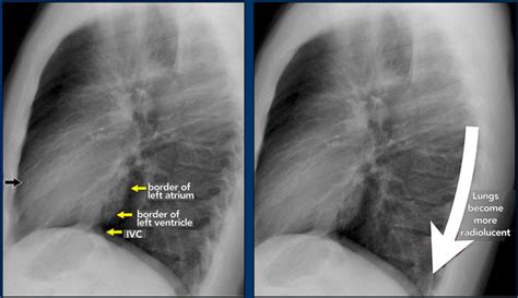 Normal Lateral Chest Xray