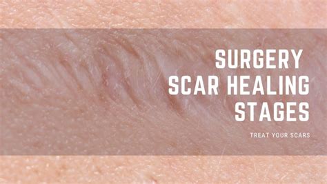 Surgery Scar Healing Stages Treat Your Scars