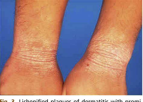 Figure 2 From Atopic Dermatitis Racial And Ethnic Differences