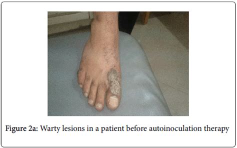Plantar warts can be refractory to attempted therapeutic interventions. infectious-diseases-Warty-lesions