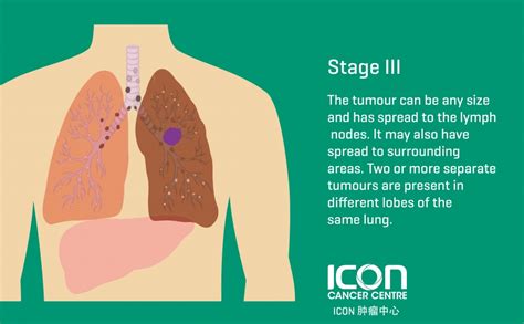 What Is Lung Cancer Symptoms Causes Icon Cancer Center China