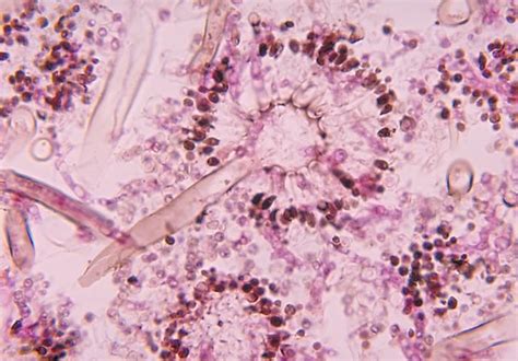 Mucormycosis and 541 with invasive aspergillosis (ia). File:Histopathologic features of aspergillosis including ...