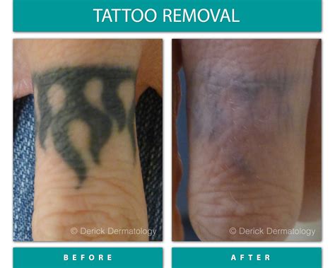 Before And After Gallery Tattoo Removal Derick Dermatology