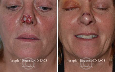 Before And After Reconstructive Surgery Results New York Ny