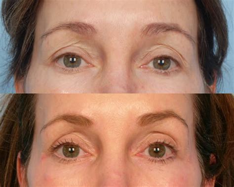 Eye Rejuvenation Santa Monica Grossman Dermatology