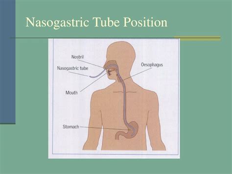 A nasogastric (ng) tube is a flexible tube of rubber or plastic that is passed through the nose, down through the esophagus, and into the stomach. PPT - Gastrointestinal Intubation Nasogastric tubes ...
