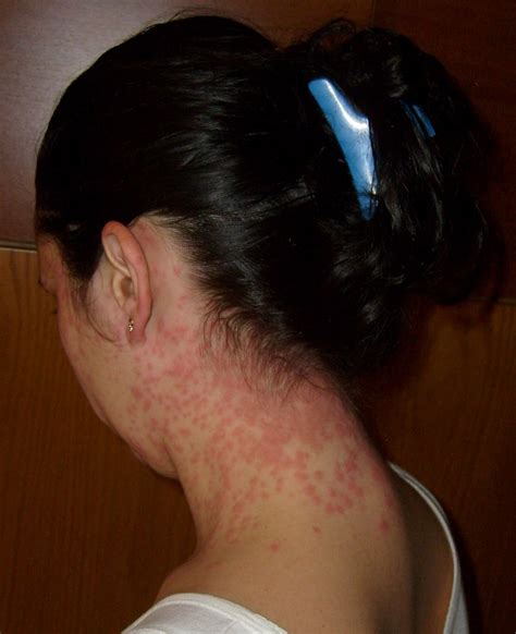 Bestandeuproctis Chrysorrhoea Skin Rash Wikipedia