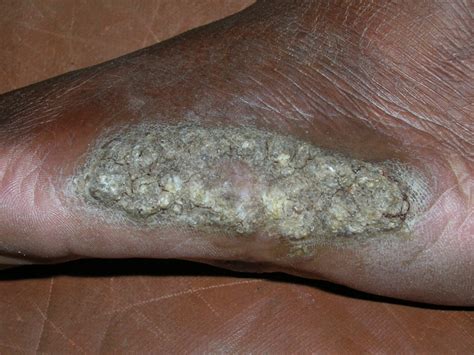 A18.42) is de meest voorkomende variant van cutane tuberculose. Tuberculosis cutis (cutane tuberculose, TBC)
