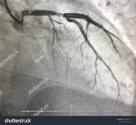 Coronary Angiogram Shown That Proximal Lad Stock Photo 1586282911