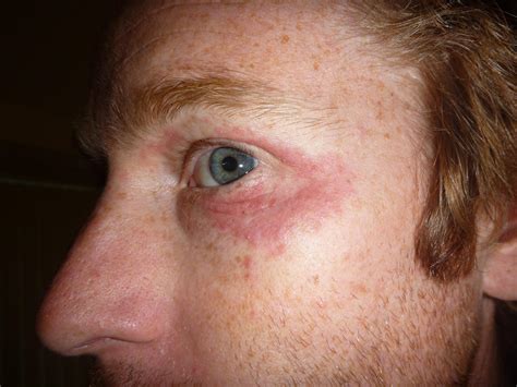 Eye Patch Damage Eyes at Norma Villeda blog