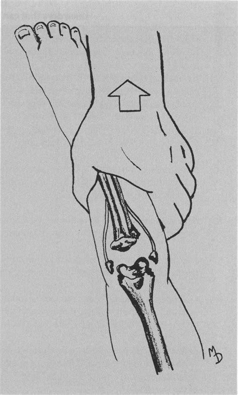 Metaphyseal Corner Fracture The Metaphyseal Tips Are Avulsed With A