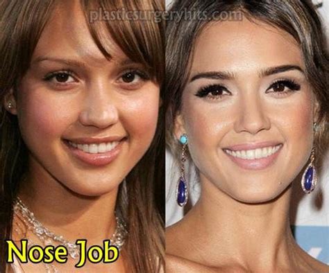 Jessica Alba Plastic Surgery Before And After Plastic Surgery Hits In