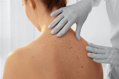 When To Consider A Skin Cancer Screening Easton Dermatology Associates Dermatologists