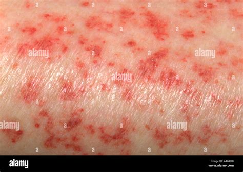 Anemia Skin Rash