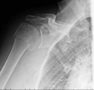 Fractura de brazo, izquierdo y derecho, sintomas, niños y ...