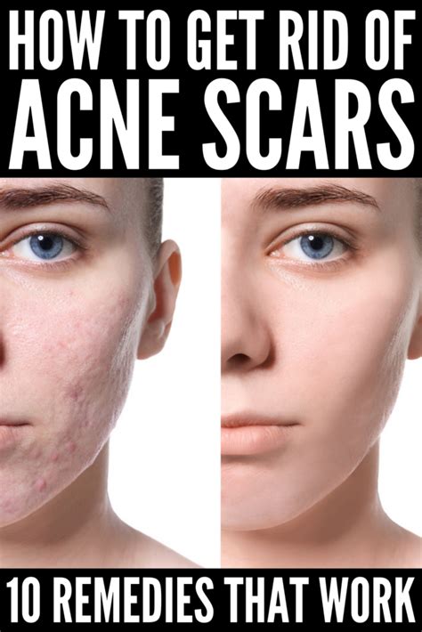 How To Get Rid Of Acne Scars 10 Products And Remedies To Try