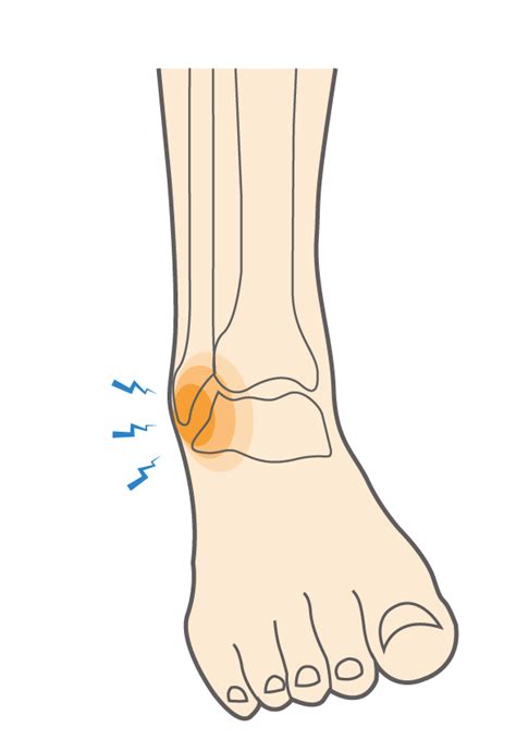 What Is A Lateral Ankle Sprain And How Do You Treat It Upswing Health