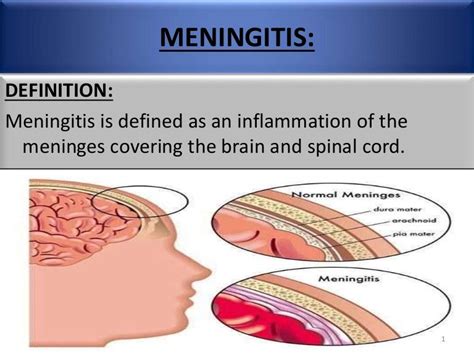 Referat Meningitis