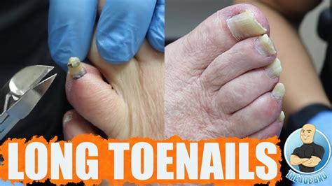 Trimming Super Thick And Long Toenails Youtube