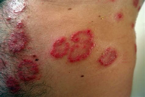 Psoriasis What Is It Pictures Causes Symptoms Treatment