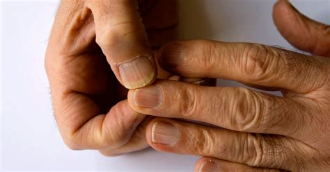 Swollen Finger Swelling Fingers Symptoms Causes Treatments Diagnosis