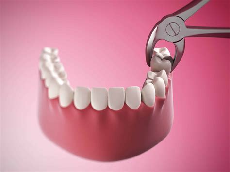 Woodland Hills Dentist Discusses The Process Of Extracting A Tooth Woodland Hills Ca