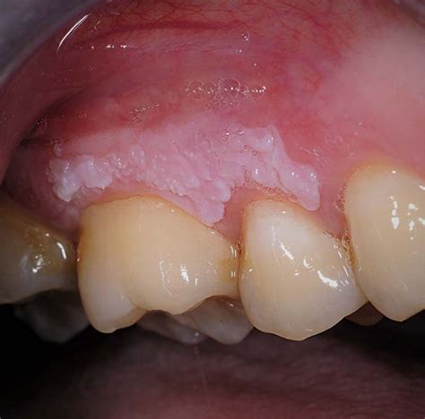 Clinical Features And Presentation Of Oral Potentially Malignant