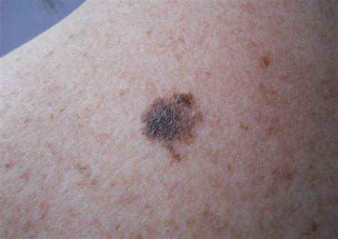 Early Superficial Melanoma Hot Sex Picture