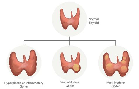 Toxic Nodular Goitre Holistic Alternatives Thyroid Aid