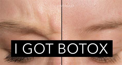 Chin Botox Road Test Results Skin Careless